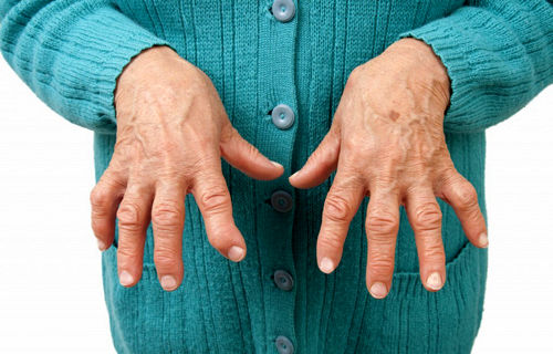 علل، علایم و علاج بیماری آرتریت روماتوئید