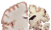آلزایمر در خواب حمله می‌کند