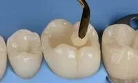 تفاوت دندانپزشکی بیومیمتیک با روش های دیگر ترمیم دندان