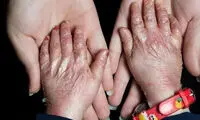 سخنگوی وزارت خارجه: تحریم‌ها حتی از بیماران پروانه‌ای هم نگذشتند!