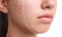 هزینه درمان جای جوش و اسکار در سال 1405