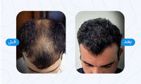 بهترین کلینیک های کاشت مو در شیراز + معرفی 10 کلینیک برتر