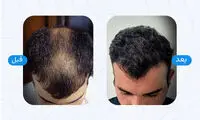 بهترین کلینیک های کاشت مو در شیراز + معرفی 10 کلینیک برتر