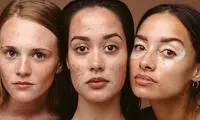 علت، جلوگیری و روش های درمان جوش هورمونی