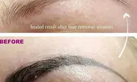 عوارض ریموور تاتو ابرو چیست؟