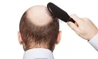 ۶ ریزمغذی موثر در جلوگیری از ریزش مو
