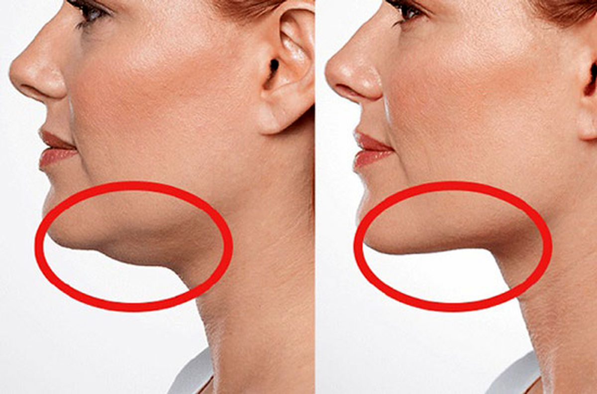اندولیفت صورت و غبغب چگونه انجام میشود؟