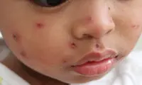 شیوع نگران‌کننده بیماری سرخک در سراسر جهان