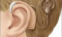 پرداخت ۴۴میلیون از هزینه کاشت حلزون شنوایی