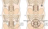 ترمیم ستون فقرات با کمک تحریک الکتریکی
