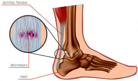 بهترین راه درمان پارگی تاندون ساق پا