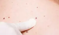 سرطان پوست؛ نشانه‌هایی که نادیده گرفته می‌شوند