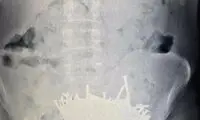 خارج کردن ۲۳۰میخ و قطعه شیشه از شکم بیمار