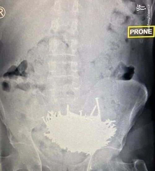 خارج کردن ۲۳۰میخ و قطعه شیشه از شکم بیمار
