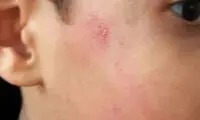 ردِ انگشتر مدیر روی صورت دانش‌آموز بعد از ۲۰ روز!