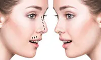 جراحی زیبایی بینی- دکتر مهرداد مقیمی