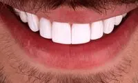 لمینت دندان ارزان و هرآنچه باید بدانید