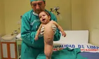 درمان دختری با سندروم پری دریایی +عکس
