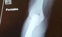 نمای اشعه X از دست قطع شده +عکس