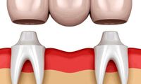 بریج دندان چیست؟ مزایا و قیمت آن