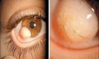 یک پدیده نادر در چشم جوان ایرانی +عکس
