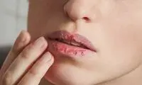 ۸ دلیل خشکی لب‌ها