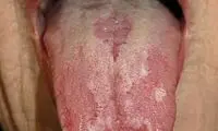 وقتی زبان ملتهب می‌شود
