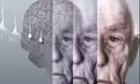 کشف عامل بروز آلزایمر