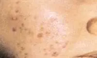 دلایل مهم جوش زدن بعد از سن بلوغ