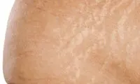 توضیح علمی ترک و کشیدگی پوست