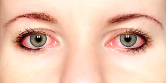 قرمز شدن چشم، علل و راه‌های درمان