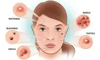 شستشوی بیش از حد صورت دلیل بروز آکنه است؟