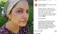 عکس مهناز افشار از صورت کبودش!
