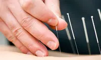 از طب سوزنی و تاثيرش بر كاهش وزن چه می دانيد؟