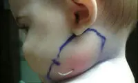 رشد پـَر در گردن یک کودک 7 ماهه! +عکس