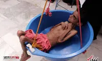 قحطی و گرسنگی وحشتناک در یمن (۱۶+)