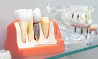 ایمپلنت دندان اشترومن سوئیسی چیست؟