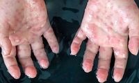 چند نفر در جهان به آبله میمون مبتلا شدند؟