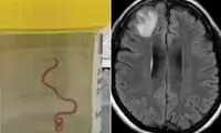 خارج کردن کرم ۱۸ سانتی‌متری از مغز یک مرد