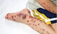 افزایش مبتلایان تب کریمه کنگو در ایران