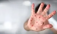 آبله میمونی تبدیل به پاندمی می‌شود؟