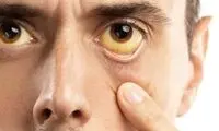 لکه‌های زرد چشم نشانه اولیه کدام بیماری است؟