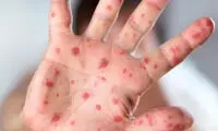 شیوع هشدار‌دهنده سرخک در این شهر ایران