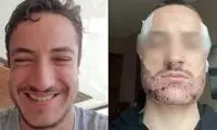 خودکشی پسر فرانسوی به‌خاطر بد شدن کاشت ریش!
