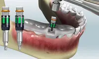 جدیدترین روش ایمپلنت چیست و چگونه انجام می‌شود؟