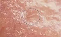 زندگی مخفیانه یک کنه مرموز در صورت ما!