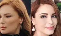 چه بلایی بر سر چهره زیبای بازیگر مشهور ترک آمده؟