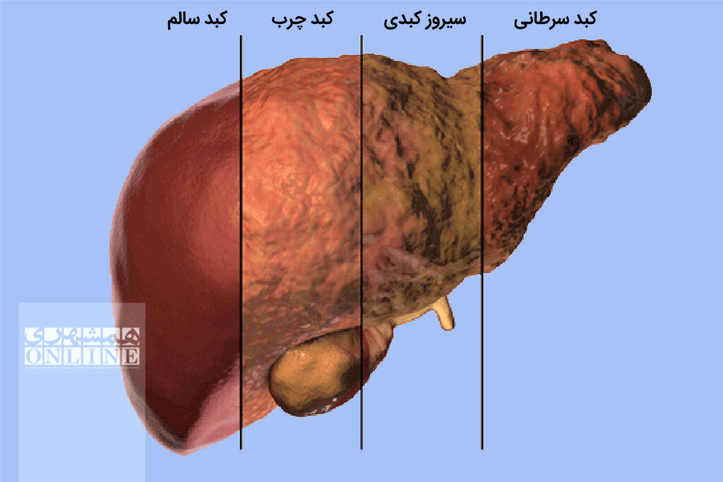 6علامت چرب شدن کبد و یک نکته‌ طلایی