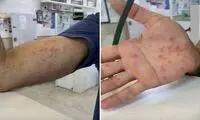 اگر این علائم را داشتید، بدانید آبله میمونی گرفته‌اید