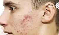 تاثیر آکنه روی صورت بر اعتمادبه‌نفس